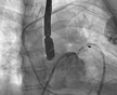 Manipal: KMC Hospital doctors perform rare cardiac intervention